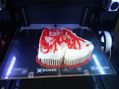 BCN3D 3D-printed medical model